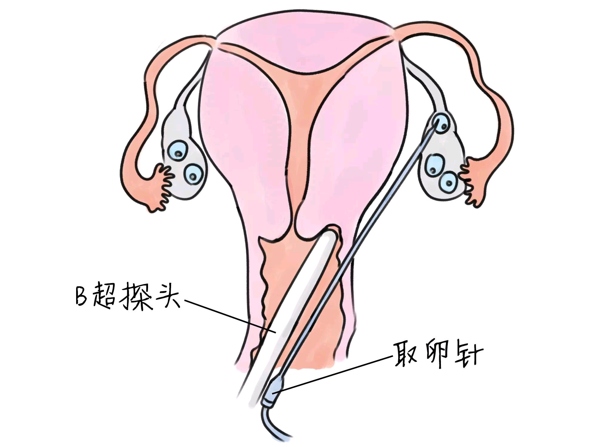 第一试管婴儿手术医院