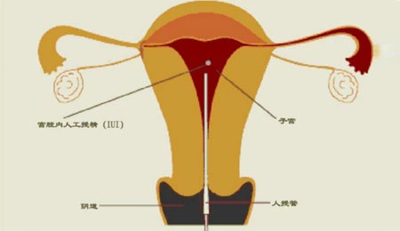 试管婴儿