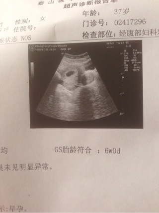 试管婴儿