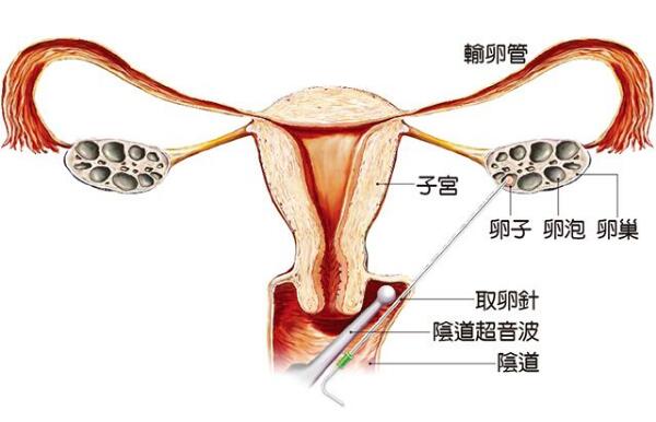 东莞捐卵